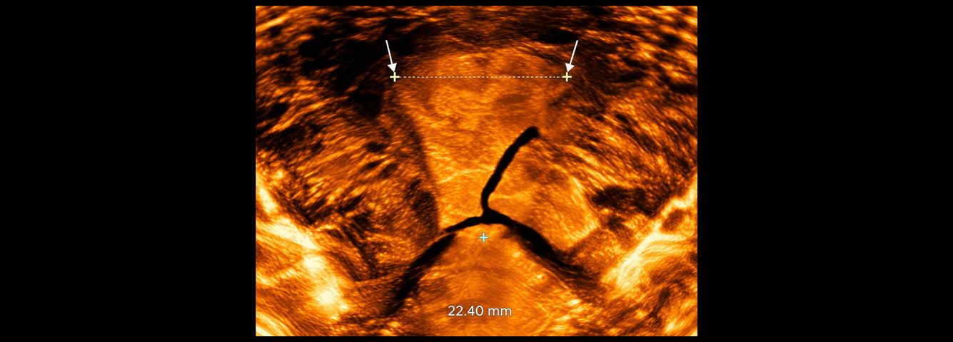 Case 1 - IUCD Malposition and IUCD Embedment