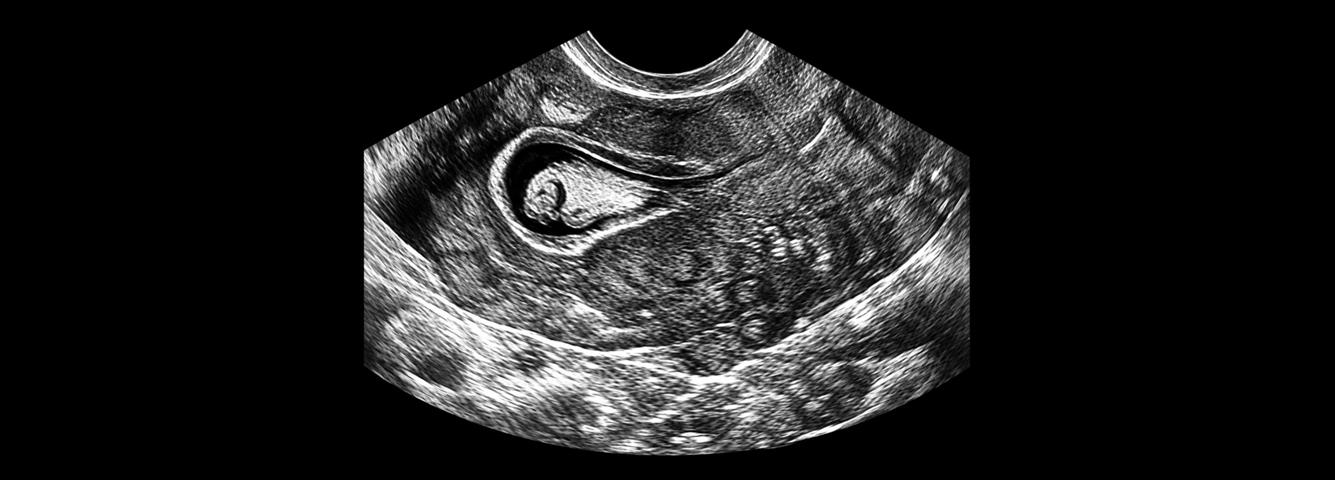 Case 2 - Abnormal Uterine Bleeding due to Prolonged Tamoxifen Therapy (AUB-I)